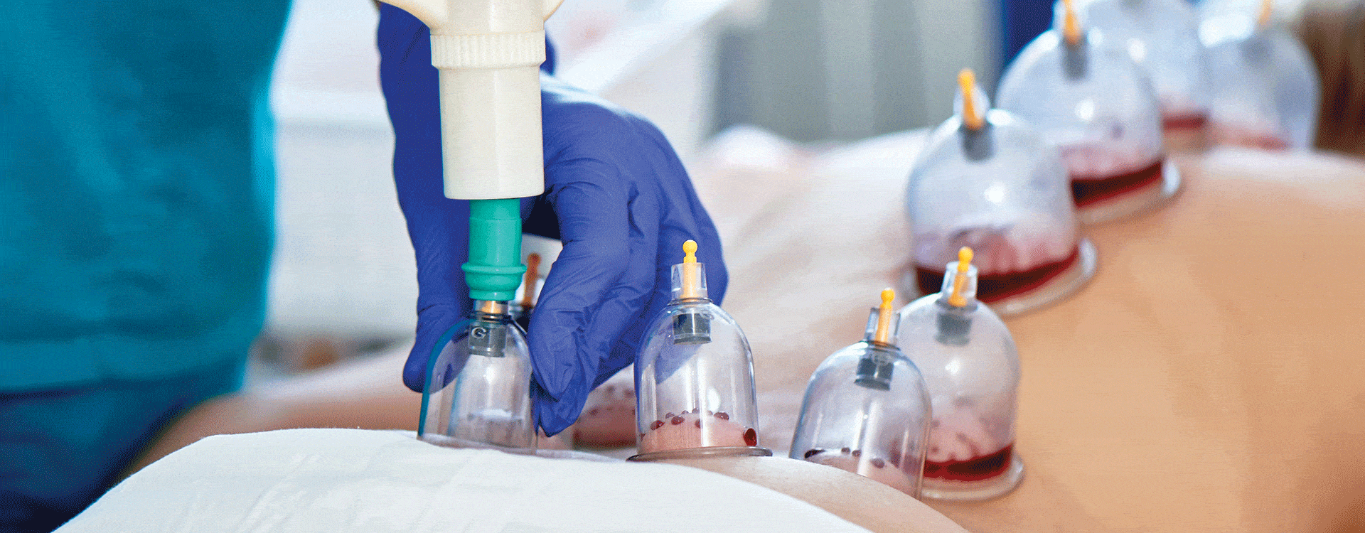Exploring Cupping Therapy